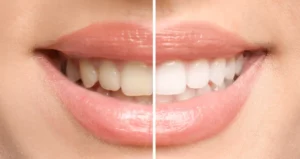 Teeth Whitening Treatment In Colorado Springs