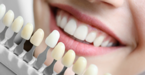 Whitening 1 - Emergency Dental of Colorado Springs