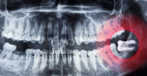 wisdom teeth - Emergency Dental of Colorado Springs