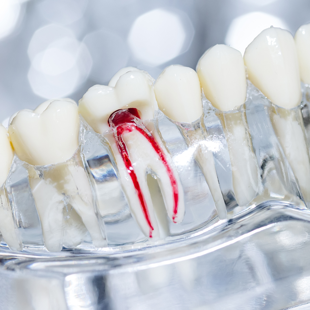 Root Canals in Colorado Springs