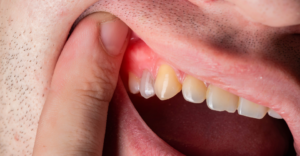 Abscessed Tooth 1 - Emergency Dental Of Colorado Springs