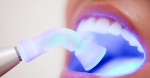 Dental Fillings In Colorado Springs