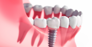 Dental Implants In Colorado Springs